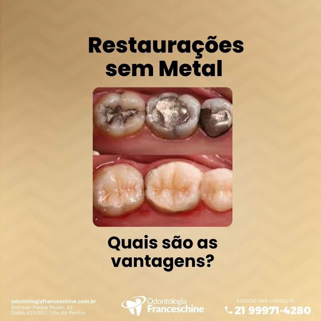 Restaurações sem metal