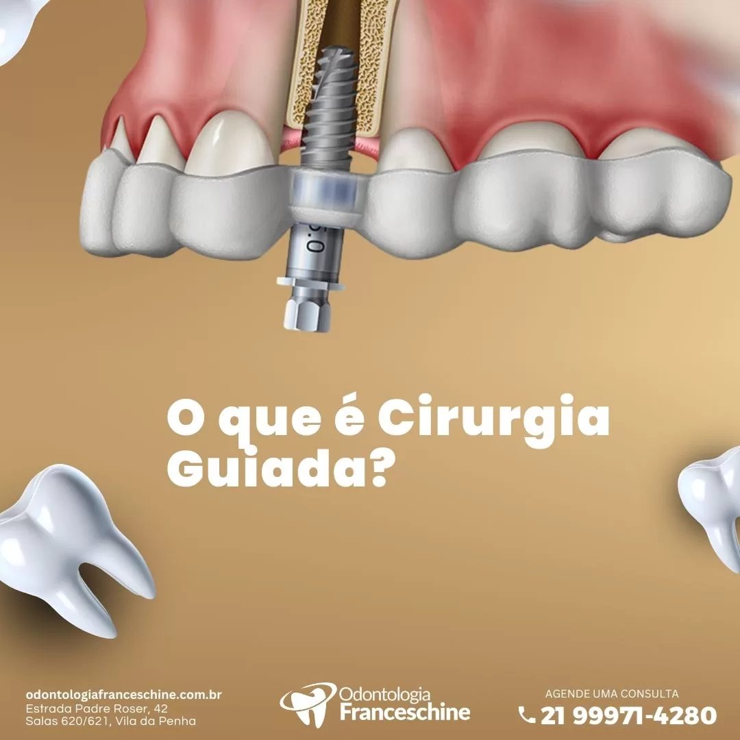 Cirurgia Guiada: Conquistando Sorrisos Mais Rápidos e Precisos com Tecnologia de Ponta!